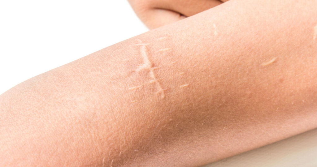 Strefa Zdrowia Wilanów w Warszawie - masaż, fizjoterapia, zabiegi - Terapia blizn po oparzeniach, pooperacyjnych