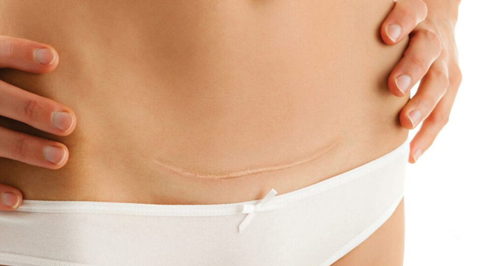 Strefa Zdrowia Wilanów w Warszawie - masaż, fizjoterapia, zabiegi - Terapia blizny po Cesarskim cięciu